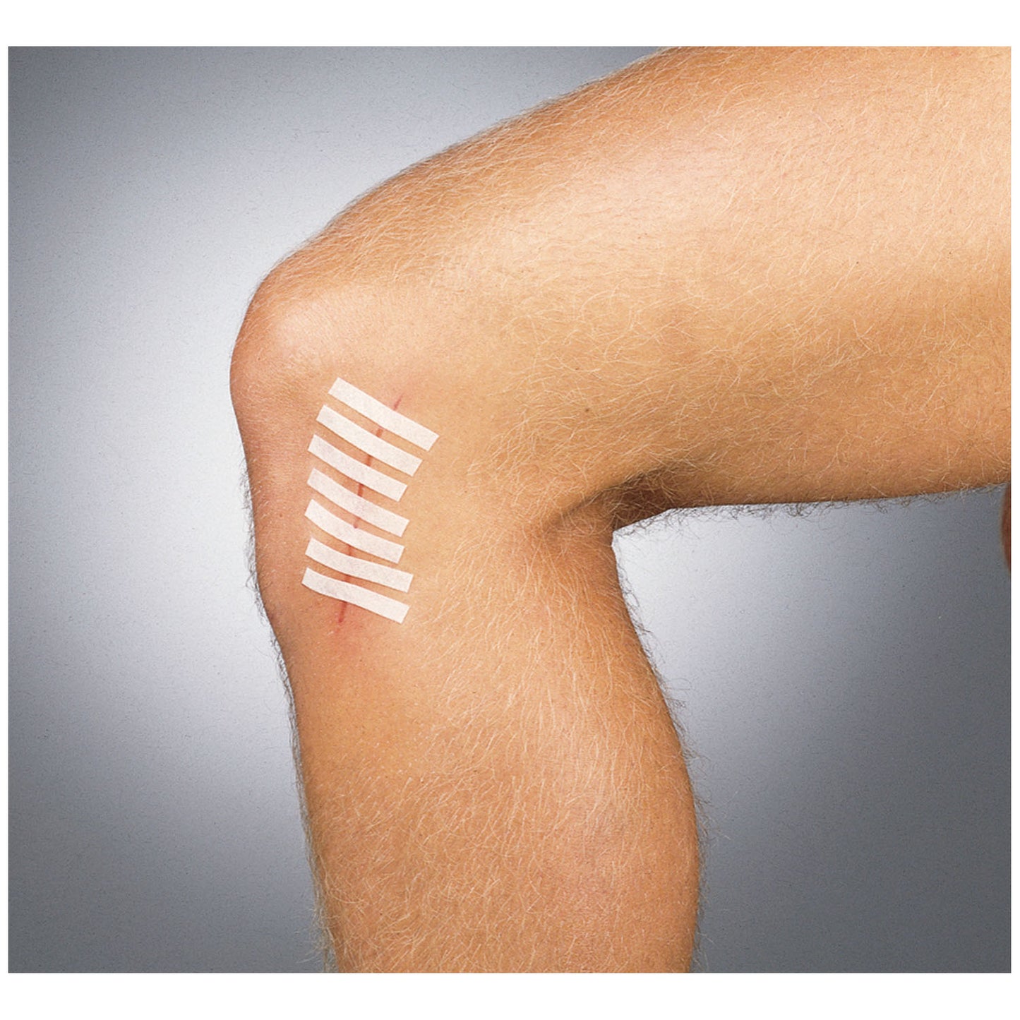 GENTELL SUTURE STRIP WOUND CLOSURE STRIPS